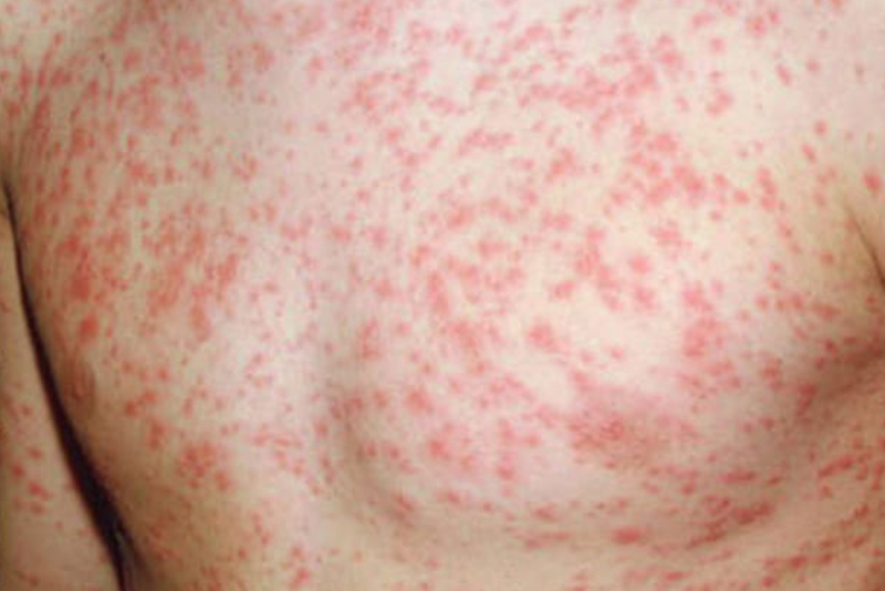 ढोरपाटनमा फैलिएको दादुरा अझै नियन्त्रणमा आएन